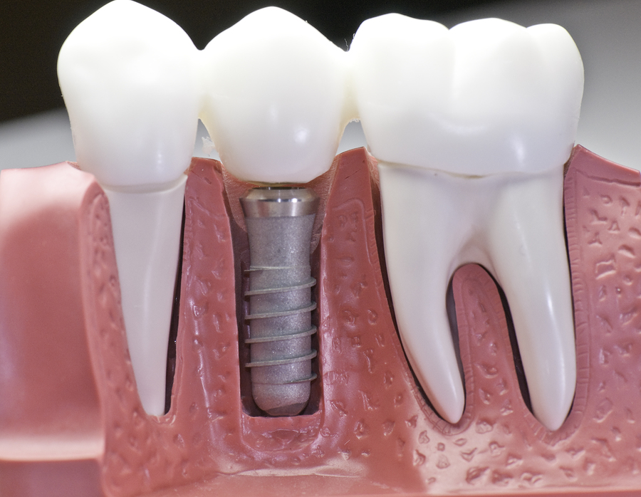 dental implants in Kitchener, ON